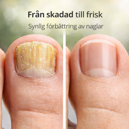 MycoNail™ Nail fungus gel | Minskar synlig nagelsvamp med upp till 97 % inom 72 timmar