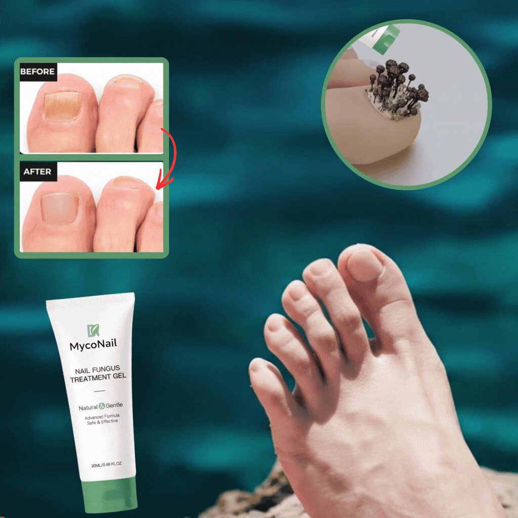 MycoNail™ Nail fungus gel | Minskar synlig nagelsvamp med upp till 97 % inom 72 timmar