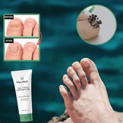 MycoNail™ Nail fungus gel | Minskar synlig nagelsvamp med upp till 97 % inom 72 timmar